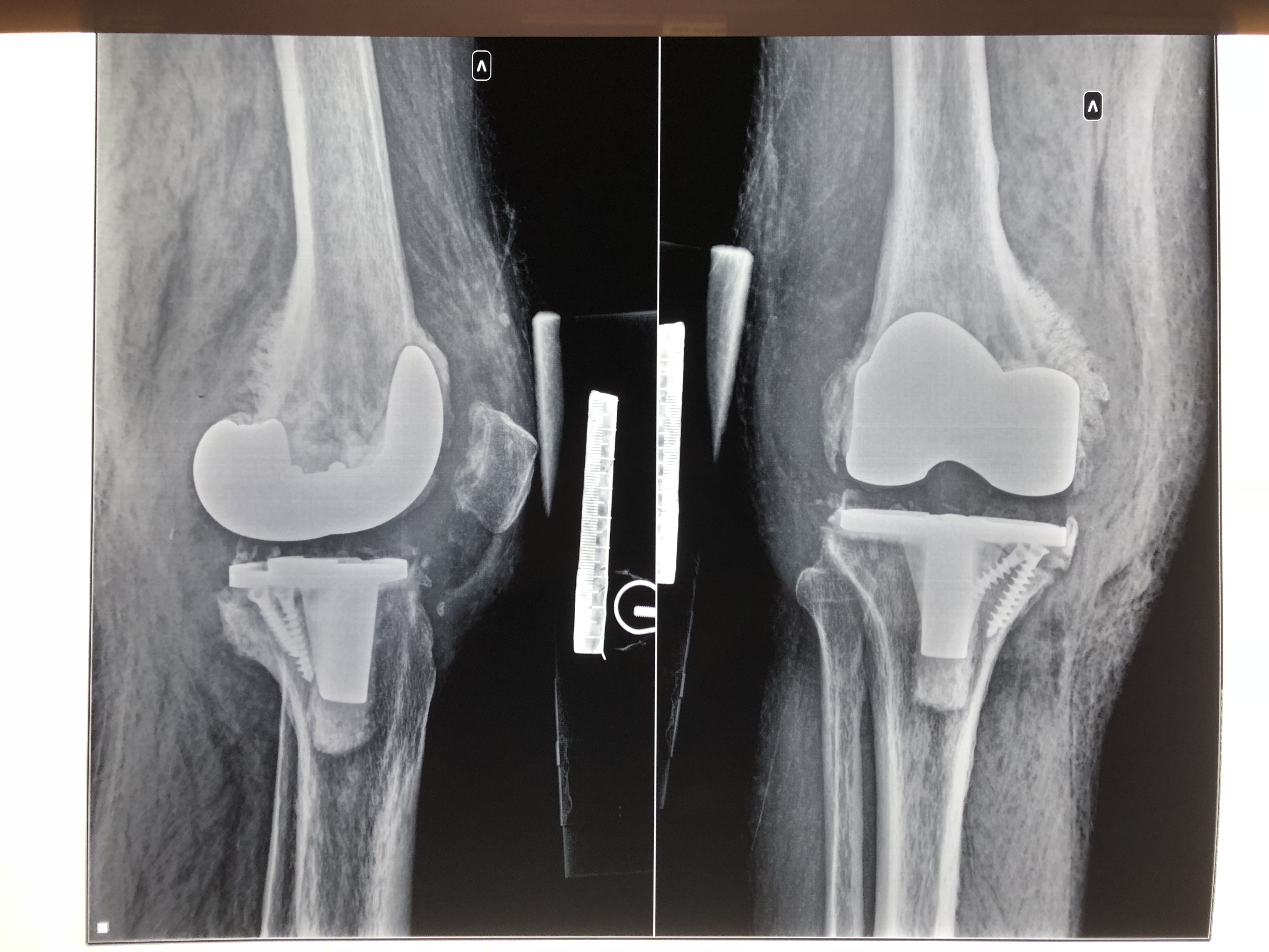 Реабилитация после операции по замене коленного